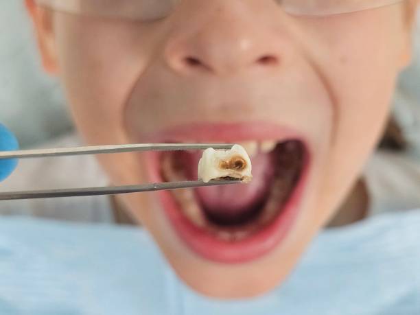 Best Cracked Tooth Emergency Dentist  in Glen Lyon, PA
